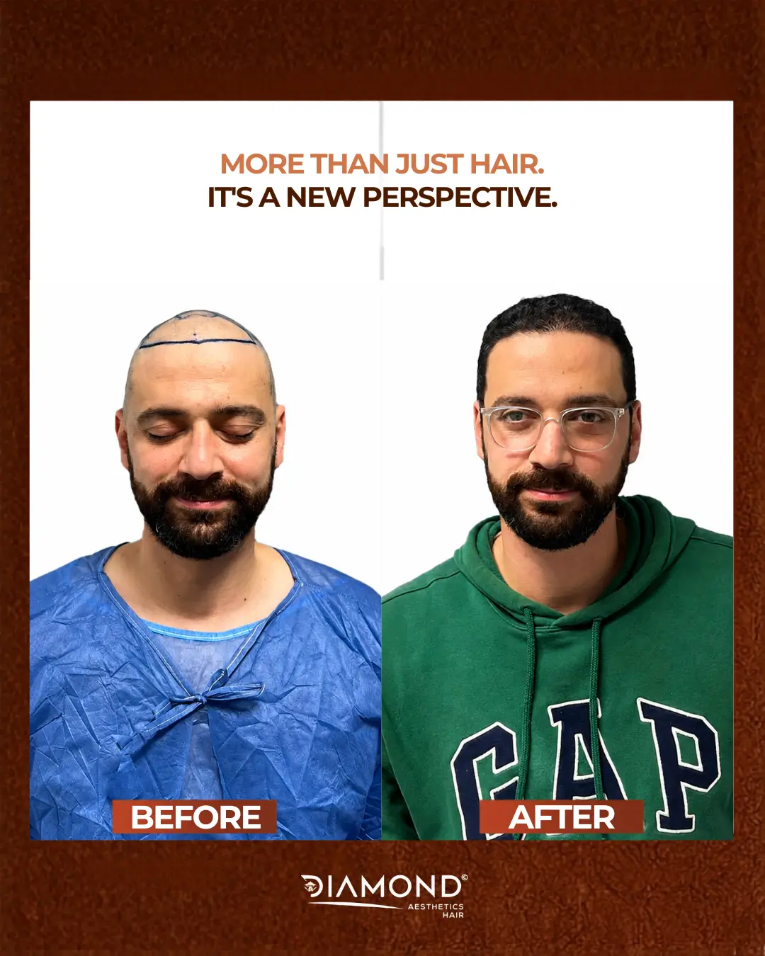 نتيجة زراعة شعر 1