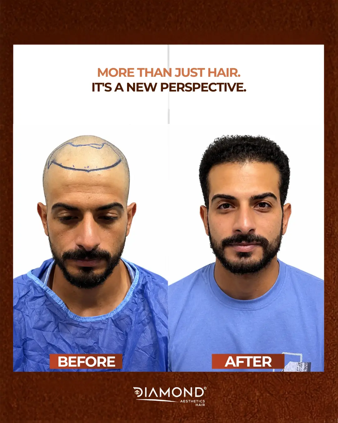 نتيجة زراعة شعر 2