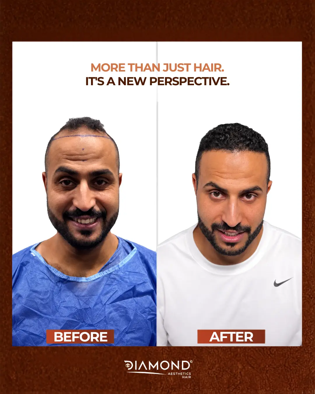 نتيجة زراعة شعر 4