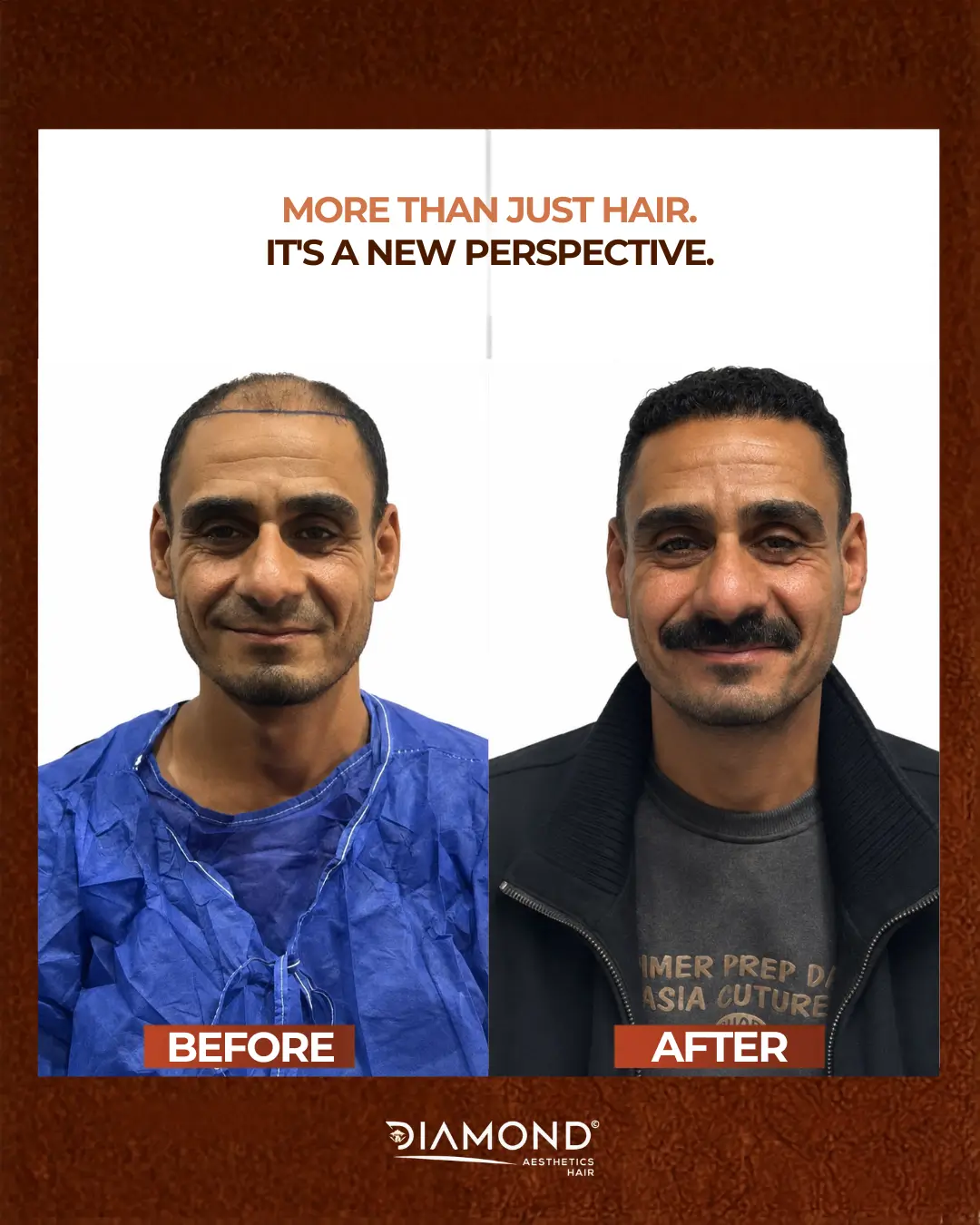 نتيجة زراعة شعر 5