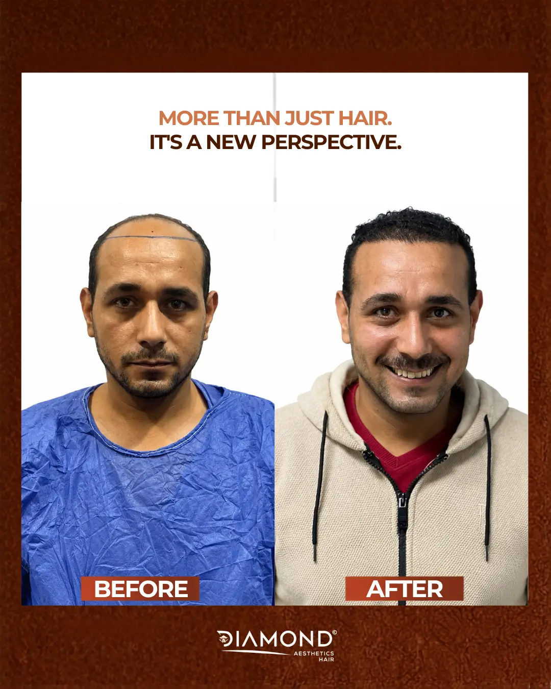 نتيجة زراعة شعر 6