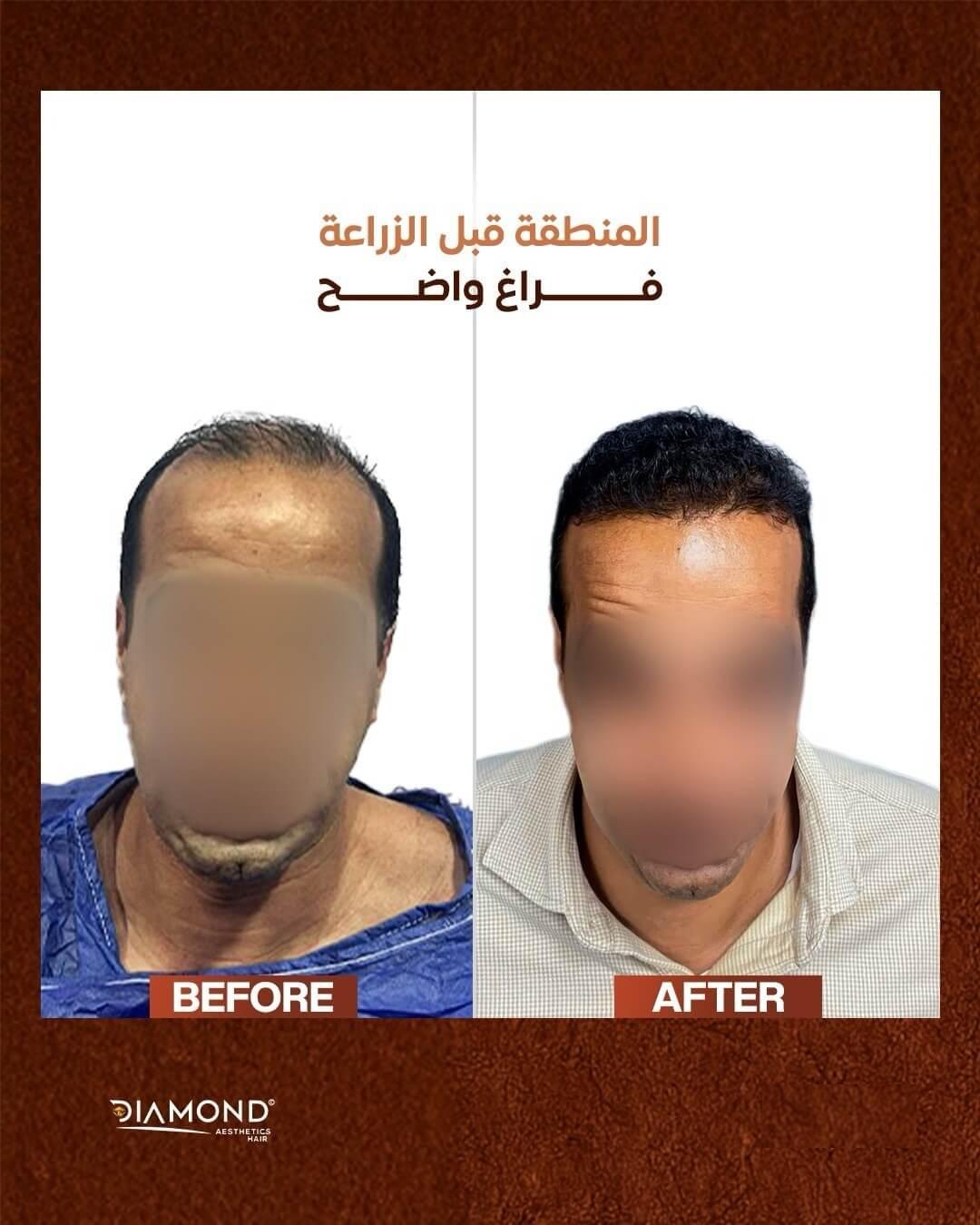 زراعة الشعر قبل وبعد في عيادات دايموند