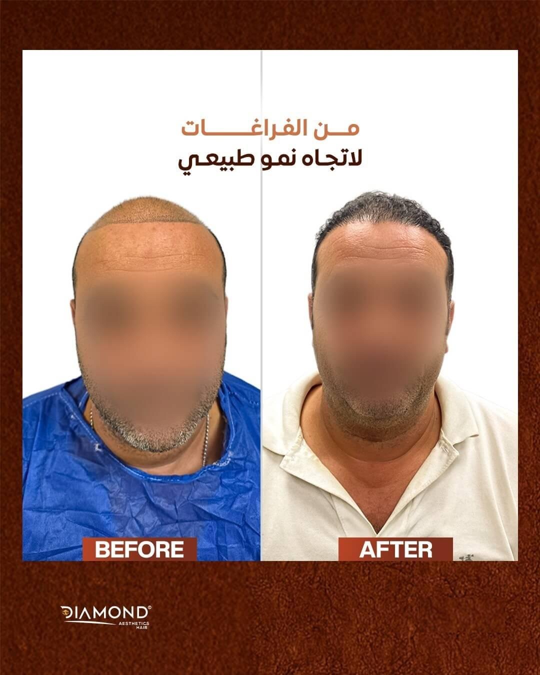 صور قبل وبعد زراعة الشعر لحالة حقيقية في عيادات دايموند بالقاهرة