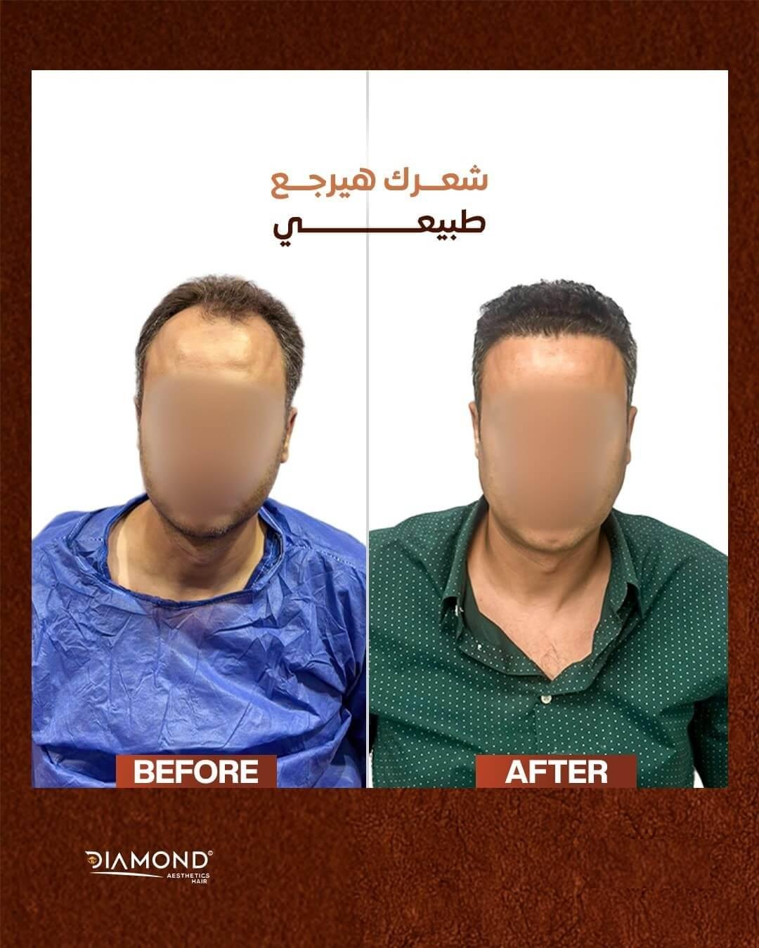 نتيجة زراعة الشعر بعد سنة في عيادات دايموند
