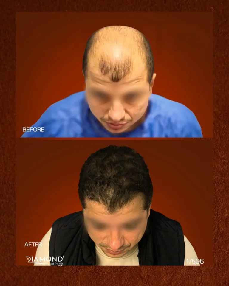 زراعة واستعادة الشعر — قبل وبعد | Diamond Aesthetics
