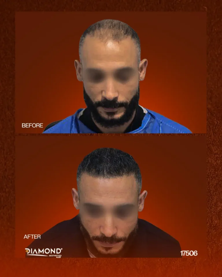 زراعة واستعادة الشعر — قبل وبعد | Diamond Aesthetics