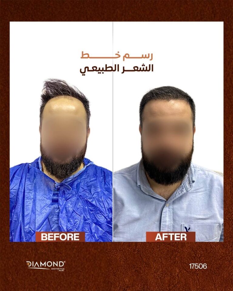 — Before & After | Diamond Aesthetics